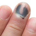 Finger nail injury prevention